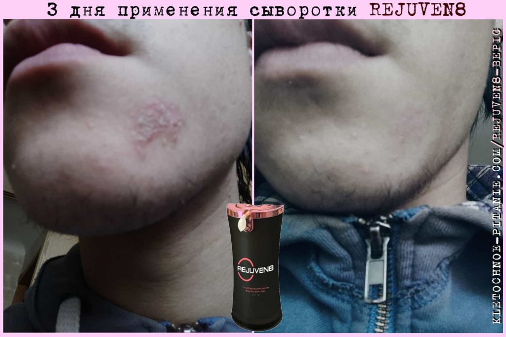 Как действует Rejuven8
