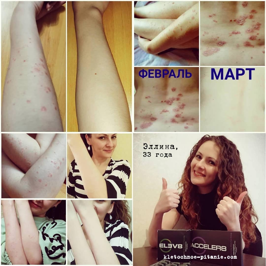 bepic psoriasis cure